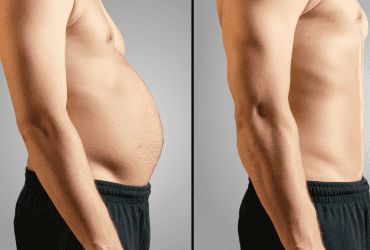 Bariatric Surgery in Islamabad